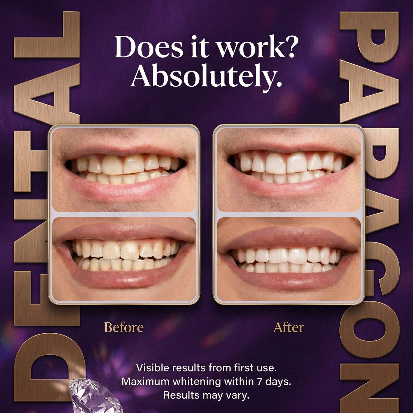 Purple Teeth Whitening Strips - For Sensitive Teeth - Enamel Safe - Brightening - 7 Day Treatment - 14 Strips