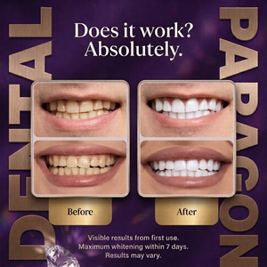 Paragon Dental Purple Teeth Whitening Strips™